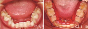 矯正歯科（床矯正）