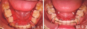 矯正歯科（床矯正）