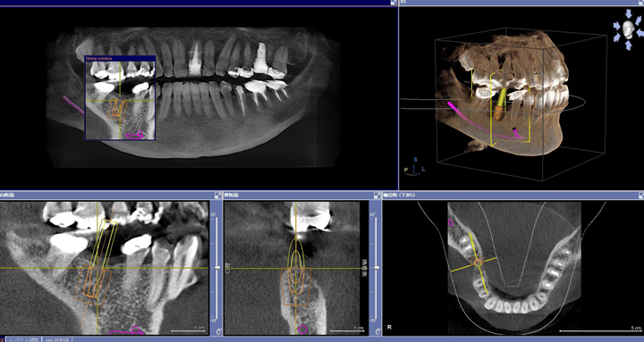 最新式歯科用CT