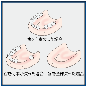 インプラント