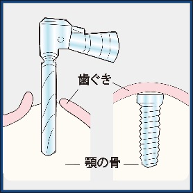 インプラント