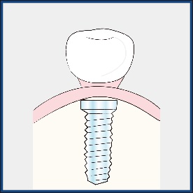 インプラント