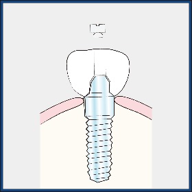 インプラント