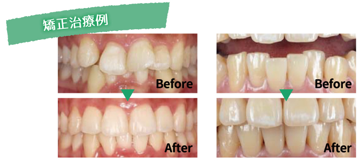 矯正治療例