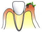 薬で治す歯周病