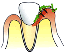 薬で治す歯周病