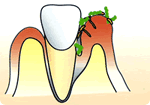 薬で治す歯周病