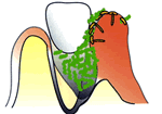 薬で治す歯周病