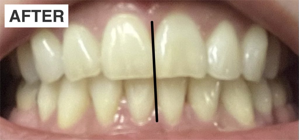 マウスピースによる再矯正後の前歯の状態（AFTER）